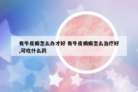 有牛皮癬怎么辦才好 有牛皮病癬怎么治療好,可吃什么藥