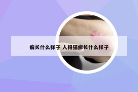 癬長什么樣子 人得貓癬長什么樣子