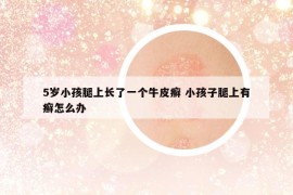 5歲小孩腿上長了一個牛皮癬 小孩子腿上有癬怎么辦
