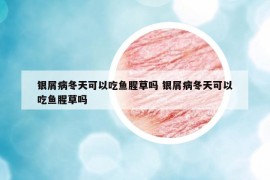 銀屑病冬天可以吃魚腥草嗎 銀屑病冬天可以吃魚腥草嗎