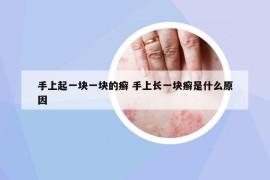 手上起一塊一塊的癬 手上長一塊癬是什么原因