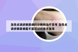 急性點滴狀銀屑病的診斷和治療思考 急性點滴狀銀屑病是不是可以終身不復(fù)發(fā)