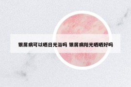 銀屑病可以曬日光浴嗎 銀屑病陽(yáng)光曬曬好嗎