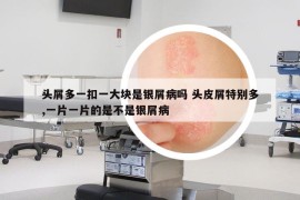 頭屑多一扣一大塊是銀屑病嗎 頭皮屑特別多,一片一片的是不是銀屑病