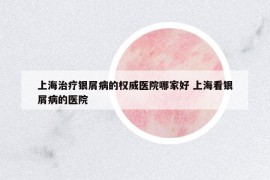 上海治療銀屑病的權(quán)威醫(yī)院哪家好 上?？淬y屑病的醫(yī)院