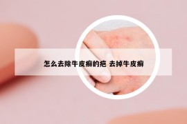 怎么去除牛皮癬的疤 去掉牛皮癬