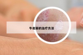 牛皮蘚的治療方法
