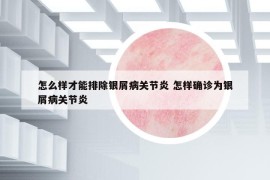 怎么樣才能排除銀屑病關(guān)節(jié)炎 怎樣確診為銀屑病關(guān)節(jié)炎