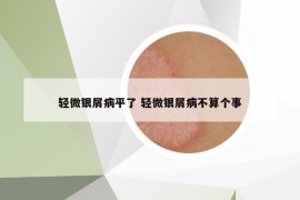 輕微銀屑病平了 輕微銀屑病不算個(gè)事