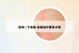 咨詢一下皮癬 皮癬治療要多少錢