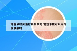 地塞米松片治療銀屑病吧 地塞米松可以治療皮膚病嗎