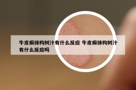 牛皮癬抹構(gòu)樹汁有什么反應(yīng) 牛皮癬抹構(gòu)樹汁有什么反應(yīng)嗎