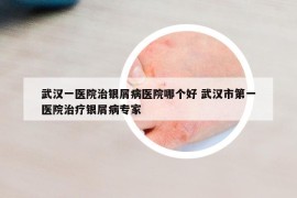 武漢一醫(yī)院治銀屑病醫(yī)院哪個(gè)好 武漢市第一醫(yī)院治療銀屑病專(zhuān)家