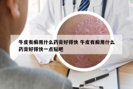 牛皮有癬用什么藥膏好得快 牛皮有癬用什么藥膏好得快一點(diǎn)貼吧