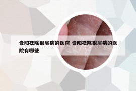 貴陽(yáng)祛除銀屑病的醫(yī)院 貴陽(yáng)祛除銀屑病的醫(yī)院有哪些