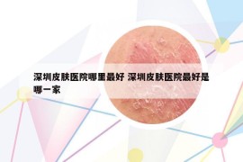 深圳皮膚醫(yī)院哪里最好 深圳皮膚醫(yī)院最好是哪一家