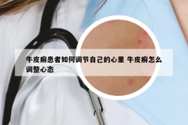 牛皮癬患者如何調節(jié)自己的心里 牛皮癬怎么調整心態(tài)