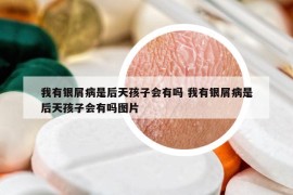 我有銀屑病是后天孩子會(huì)有嗎 我有銀屑病是后天孩子會(huì)有嗎圖片