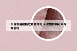 頭皮銀屑病能吃魚和蝦嗎 頭皮銀屑病可以吃雞蛋嗎