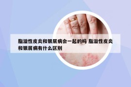 脂溢性皮炎和銀屑病會一起的嗎 脂溢性皮炎和銀屑病有什么區(qū)別