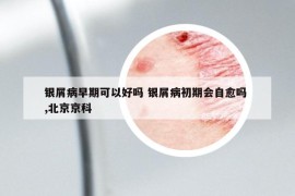 銀屑病早期可以好嗎 銀屑病初期會(huì)自愈嗎 ,北京京科