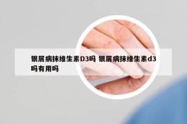 銀屑病抹維生素D3嗎 銀屑病抹維生素d3嗎有用嗎