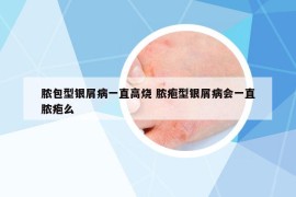膿包型銀屑病一直高燒 膿皰型銀屑病會(huì)一直膿皰么