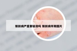 銀削病嚴重要輸液嗎 銀削病早期圖片