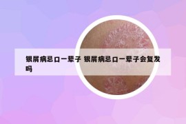 銀屑病忌口一輩子 銀屑病忌口一輩子會復(fù)發(fā)嗎