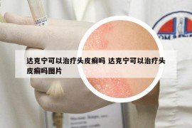 達克寧可以治療頭皮癬嗎 達克寧可以治療頭皮癬嗎圖片