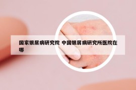 國家銀屑病研究院 中國銀屑病研究所醫(yī)院在哪