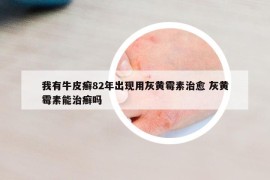 我有牛皮癬82年出現(xiàn)用灰黃霉素治愈 灰黃霉素能治癬嗎