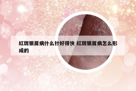 紅斑銀屑病什么針好得快 紅斑銀屑病怎么形成的