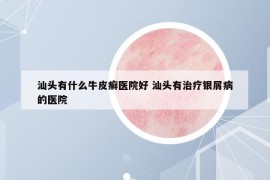 汕頭有什么牛皮癬醫(yī)院好 汕頭有治療銀屑病的醫(yī)院