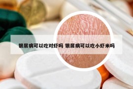 銀屑病可以吃對(duì)蝦嗎 銀屑病可以吃小蝦米嗎