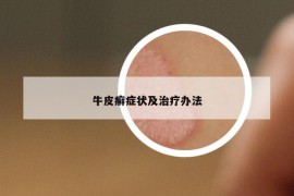 牛皮癬癥狀及治療辦法