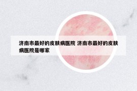 濟(jì)南市最好的皮膚病醫(yī)院 濟(jì)南市最好的皮膚病醫(yī)院是哪家