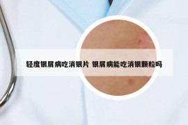 輕度銀屑病吃消銀片 銀屑病能吃消銀顆粒嗎