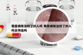 銀屑病有治好了的人嗎 銀屑病有治好了的人嗎會(huì)傳染嗎