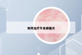如何治療牛皮癬偏方