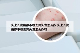 頭上長皮癬都不敢去剪頭發(fā)怎么辦 頭上長皮癬都不敢去剪頭發(fā)怎么辦呀