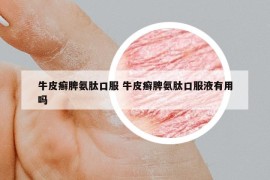 牛皮癬脾氨肽口服 牛皮癬脾氨肽口服液有用嗎