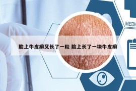 臉上牛皮癬又長了一粒 臉上長了一塊牛皮癬