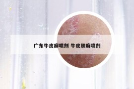 廣東牛皮癬噴劑 牛皮膚癬噴劑