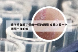 孩子后背起了像癬一樣的圓圈 皮膚上長(zhǎng)一個(gè)圓圈一樣的癬