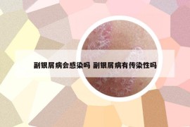 副銀屑病會(huì)感染嗎 副銀屑病有傳染性嗎