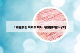 t細(xì)胞會(huì)影響銀屑病嗎 t細(xì)胞影響懷孕嗎