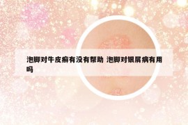 泡腳對牛皮癬有沒有幫助 泡腳對銀屑病有用嗎