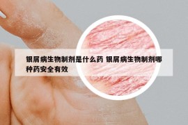 銀屑病生物制劑是什么藥 銀屑病生物制劑哪種藥安全有效