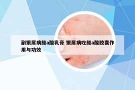 副銀屑病維a酸乳膏 銀屑病吃維a酸膠囊作用與功效